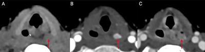 Case Report: Nine-year-old with parathyroid adenoma within the piriform sinus